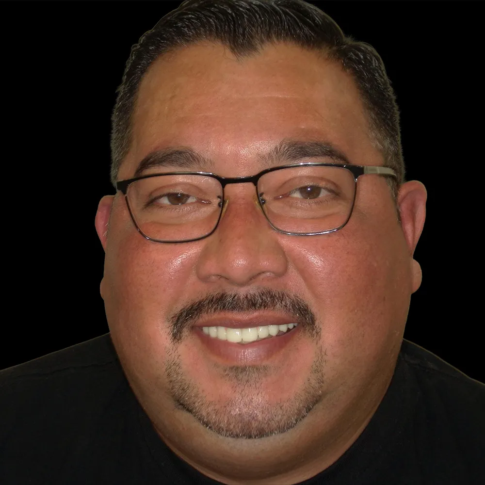 After All-on-4 Procedure