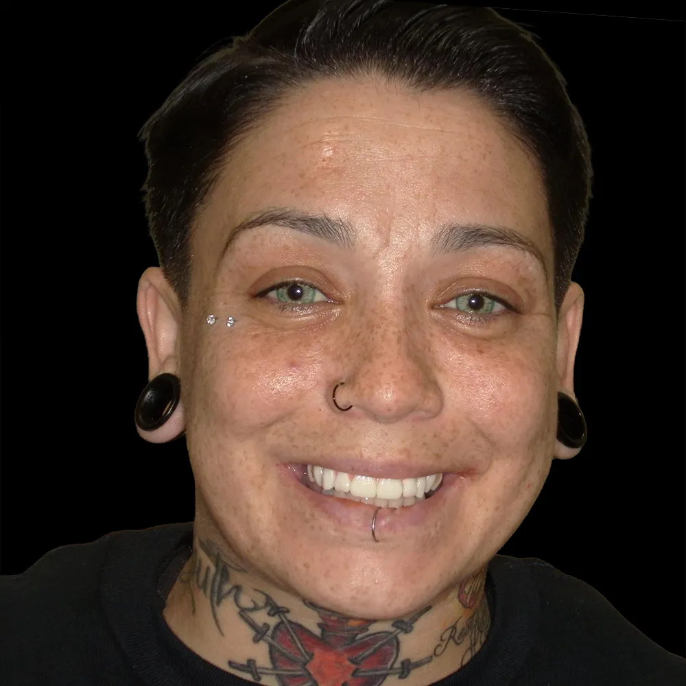 After Single Day Treatment